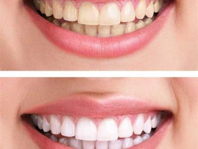 Is It Safe To Whiten Teeth