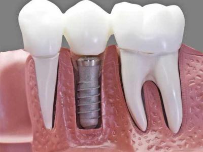 Questions You Should Ask Before Getting A Dental Implant