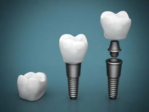 Dental Implants Winnipeg