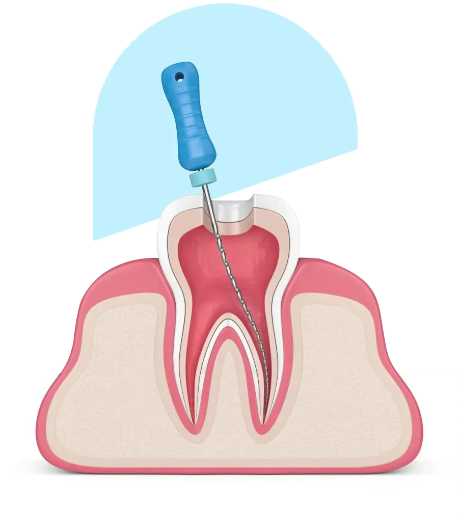 Root Canal image with blue design