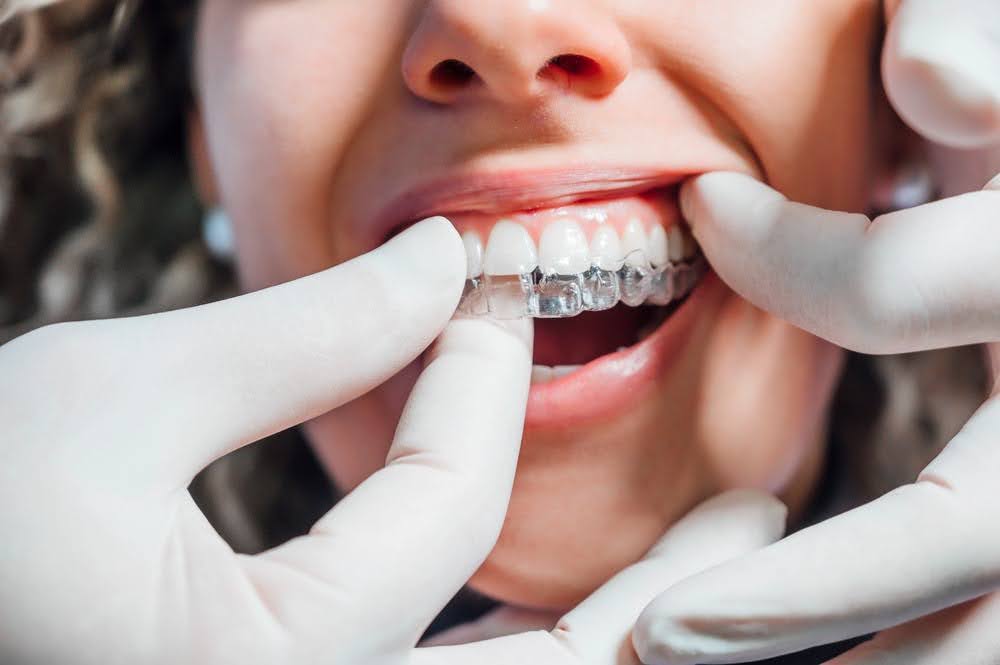 Invisalign Treatments in Winnipeg