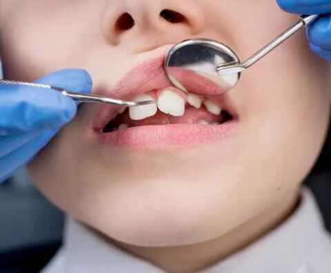 child with chipped tooth