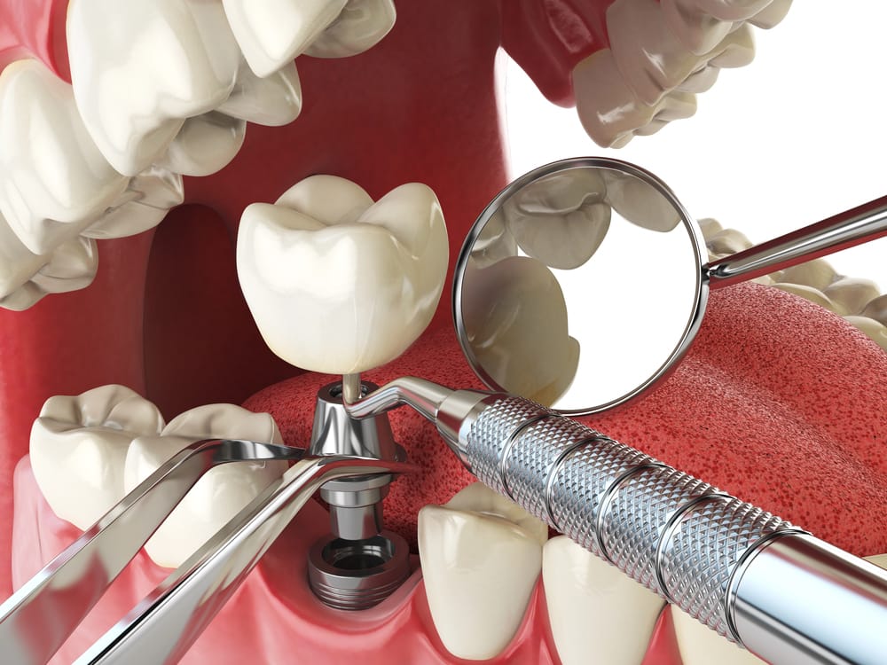 Dental Implant Consultation With A Winnipeg Dental Team
