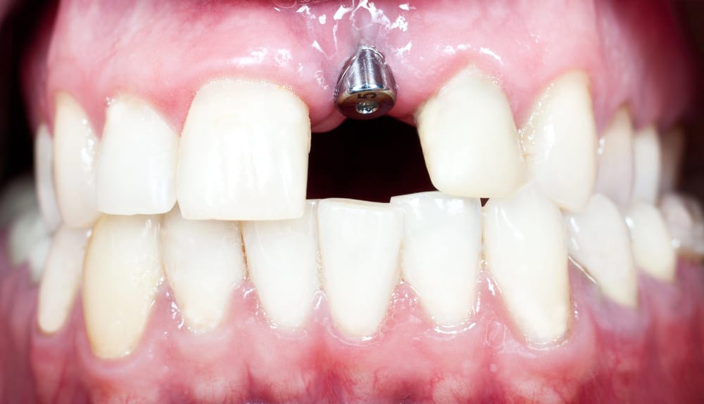 Dental Implant Replacing A Missing Front Tooth In Winnipeg