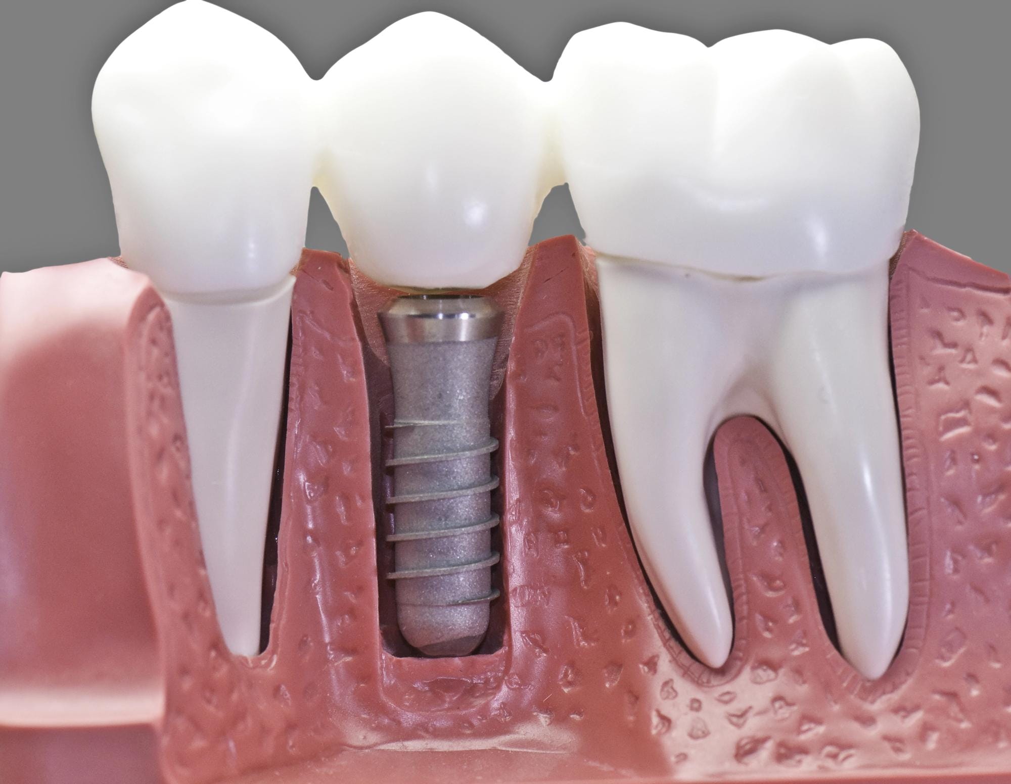 Dental implant placement illustration for patients in Winnipeg