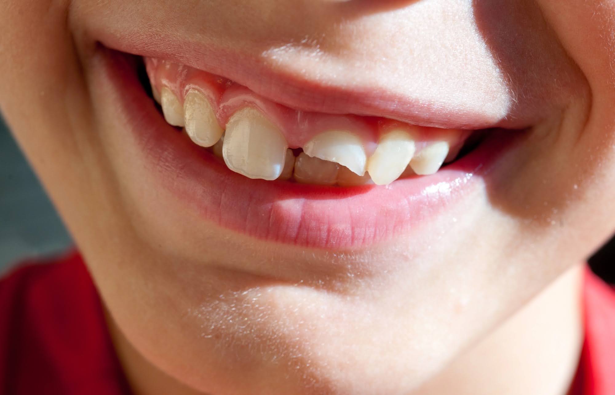 missing bottom of tooth